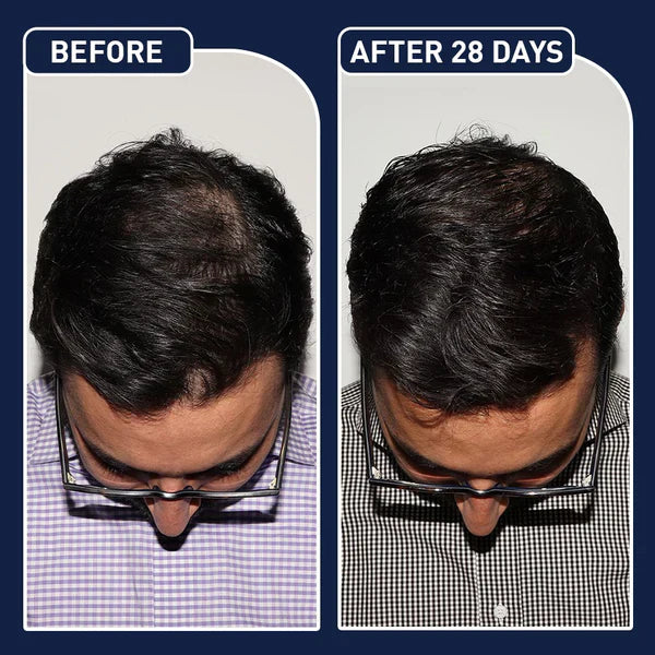 FEG Hair Growth Serum – German Technology for Faster Hair Growth سيروم FEG لتسريع نمو الشعر بتقنية ألمانية متطورة